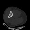 SPORK, NICO - 22.03.1976 - 02.08.2022 - CT obere Extremität - 17:51:17